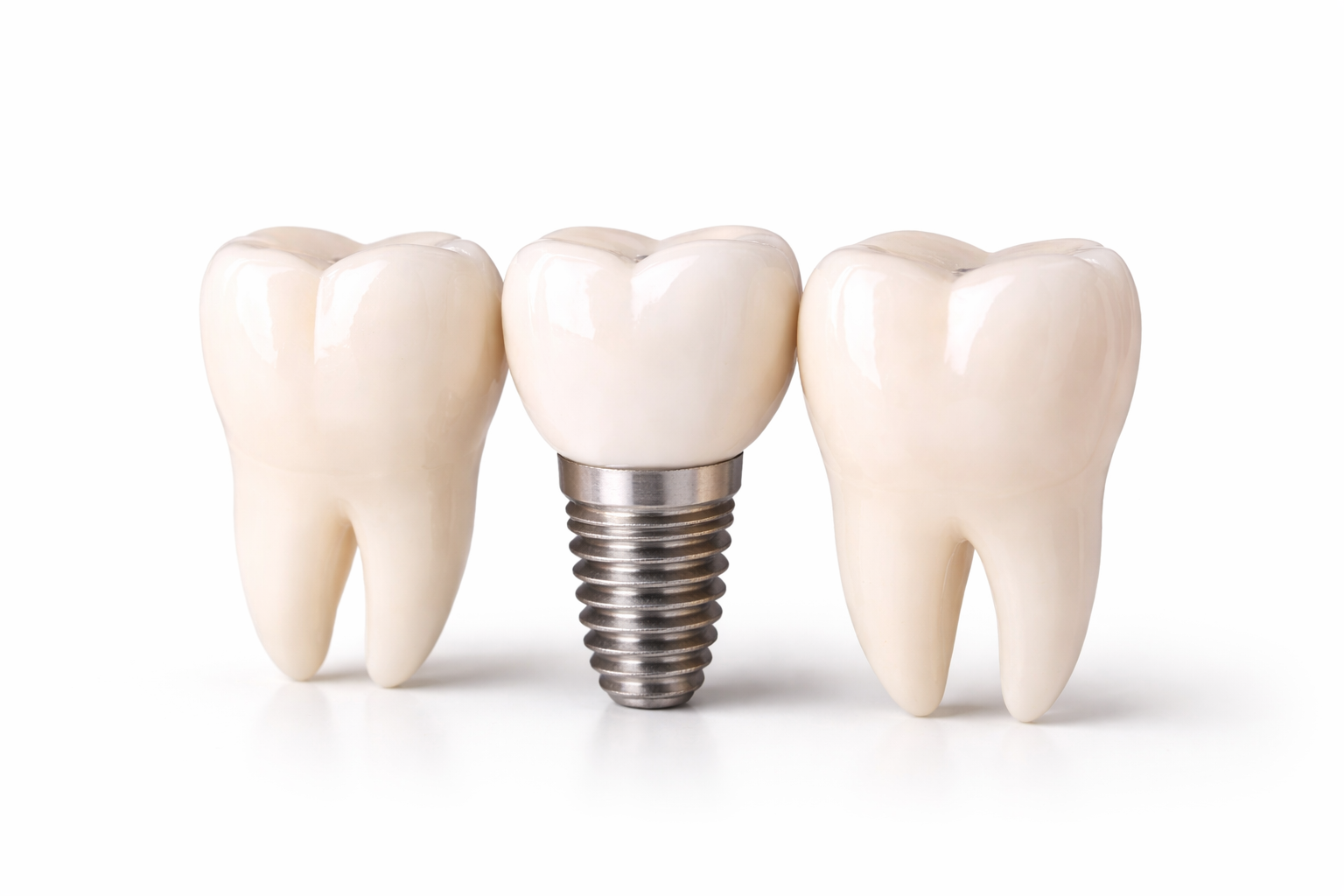 Implantes dentários: mitos e verdades que você precisa saber