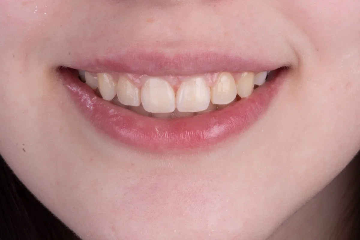 Antes - Clareamento dental