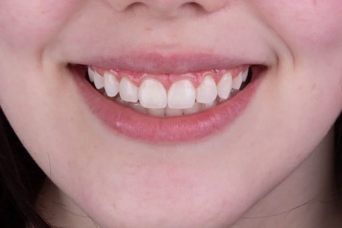 Depois - Clareamento dental