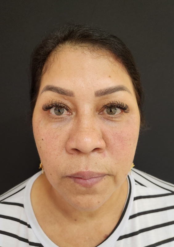 Depois — Harmonizacao Facial