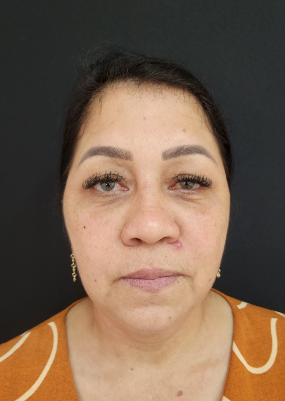 Antes — Harmonizacao Facial