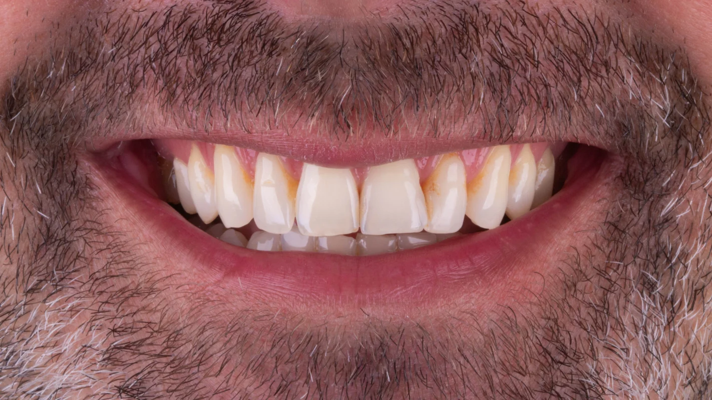 Antes — Lentes de Contato Dental