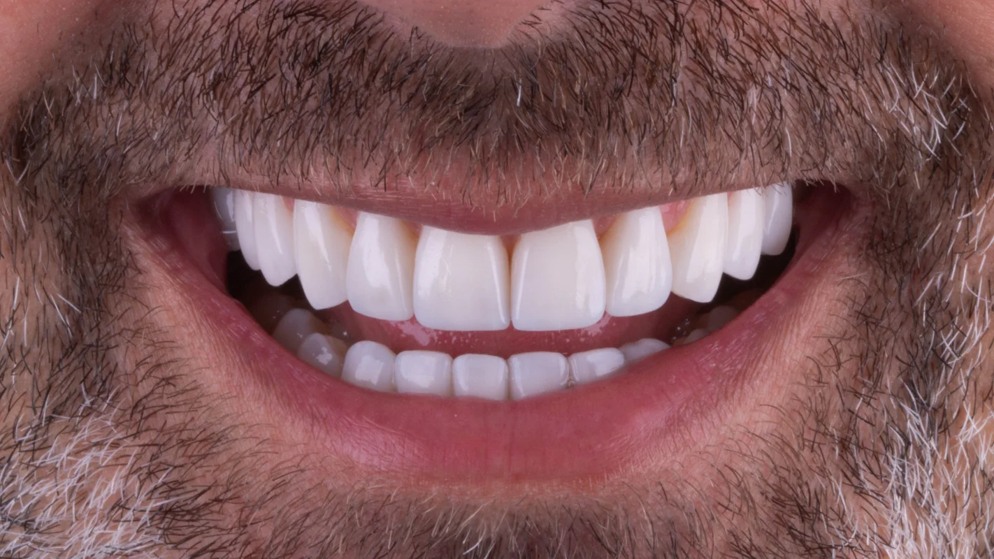 Depois — Lentes de Contato Dental