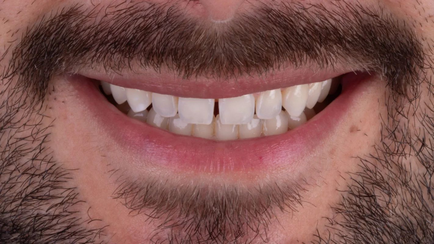 Antes — Lentes de Contato Dental