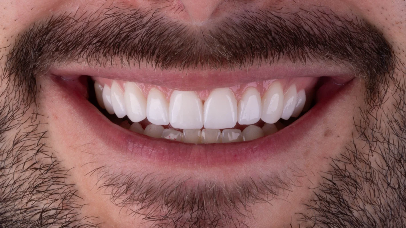 Depois — Lentes de Contato Dental