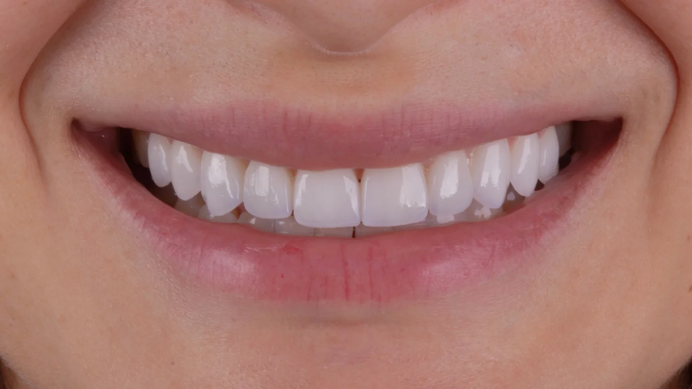 Depois — Lentes de Contato Dental