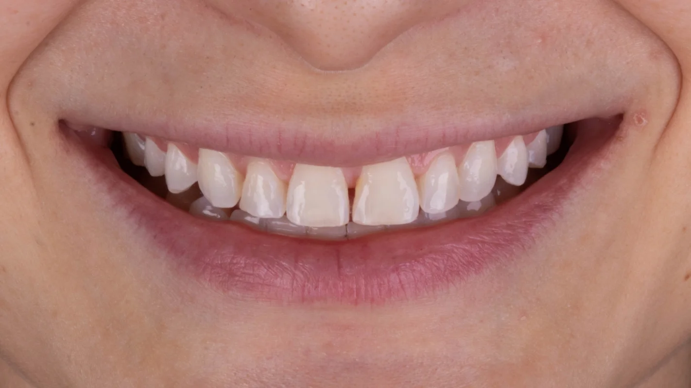 Antes — Lentes de Contato Dental