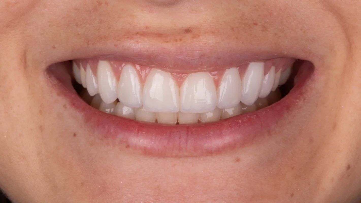 Depois — Lentes de Contato Dental