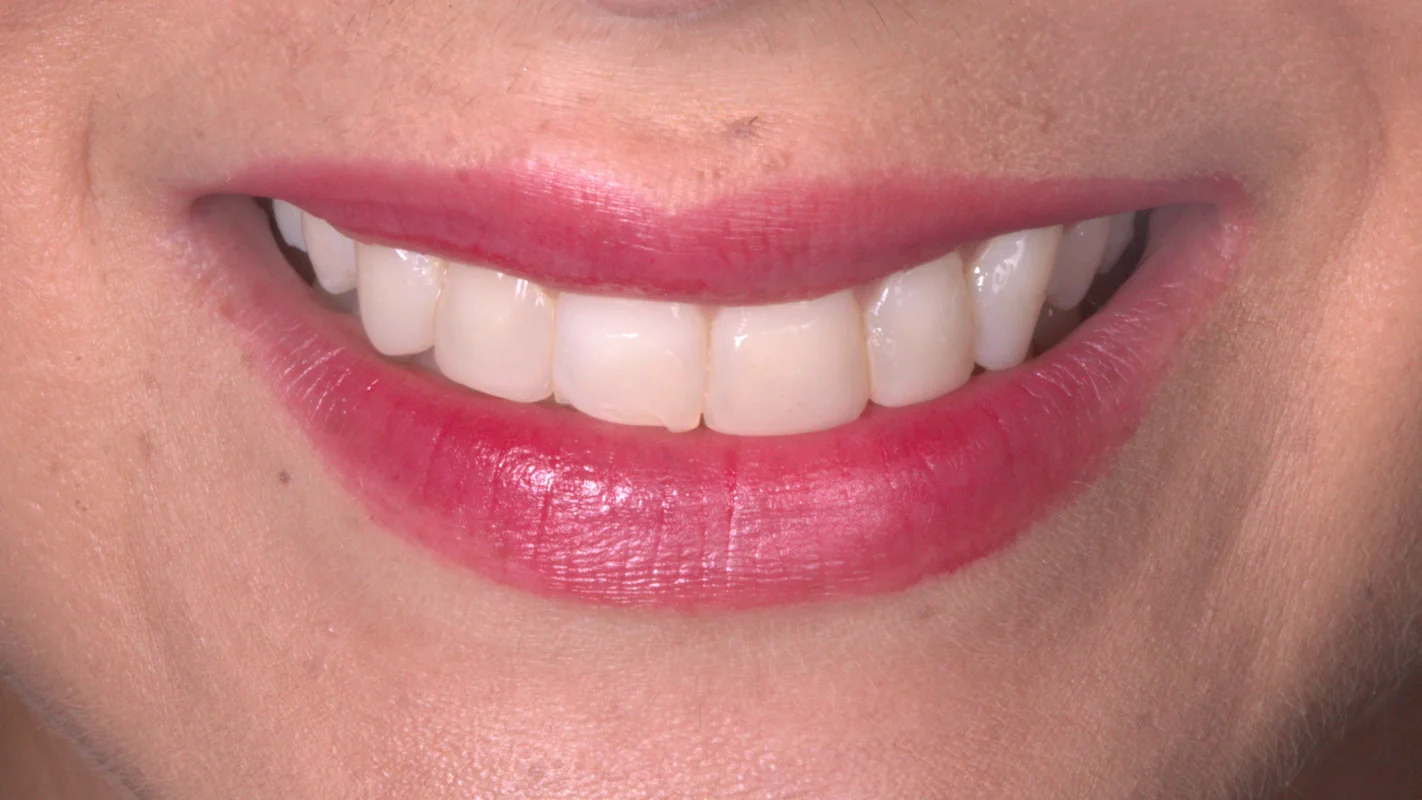 Antes — Lentes de Contato Dental