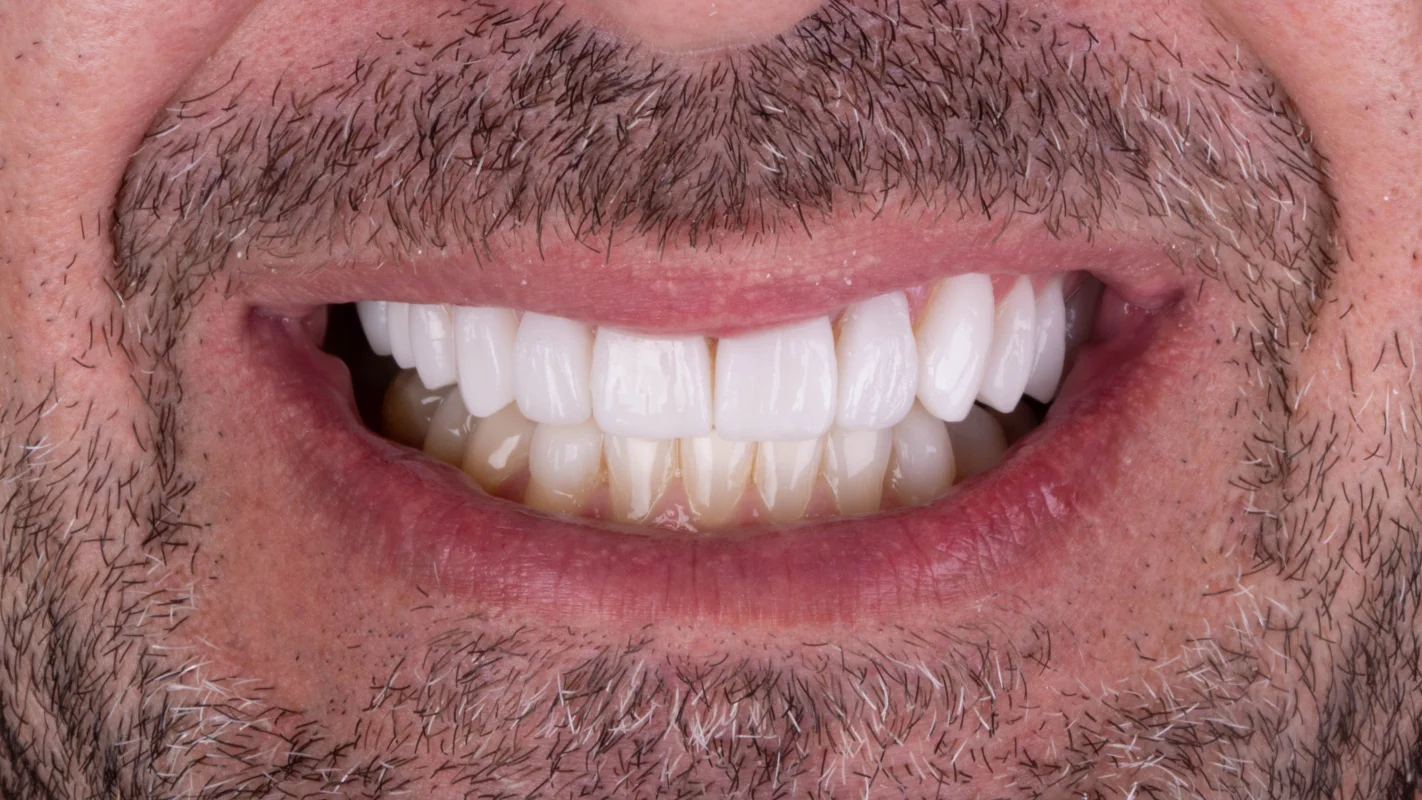 Depois — Lentes de Contato Dental