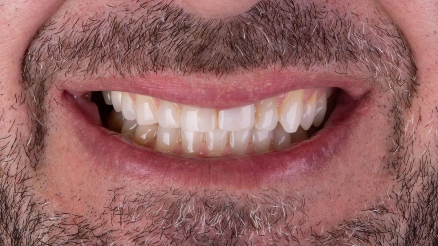 Antes — Lentes de Contato Dental