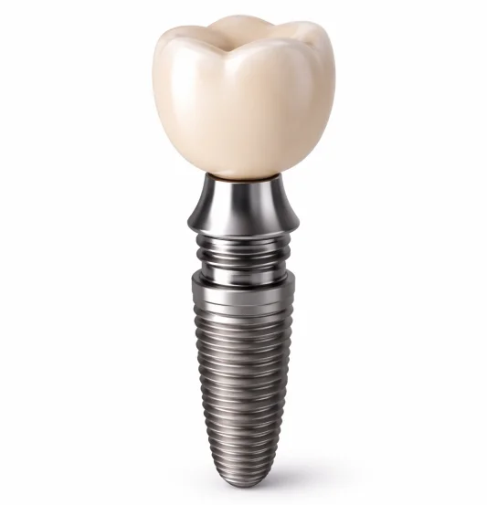 Implantes Dentários