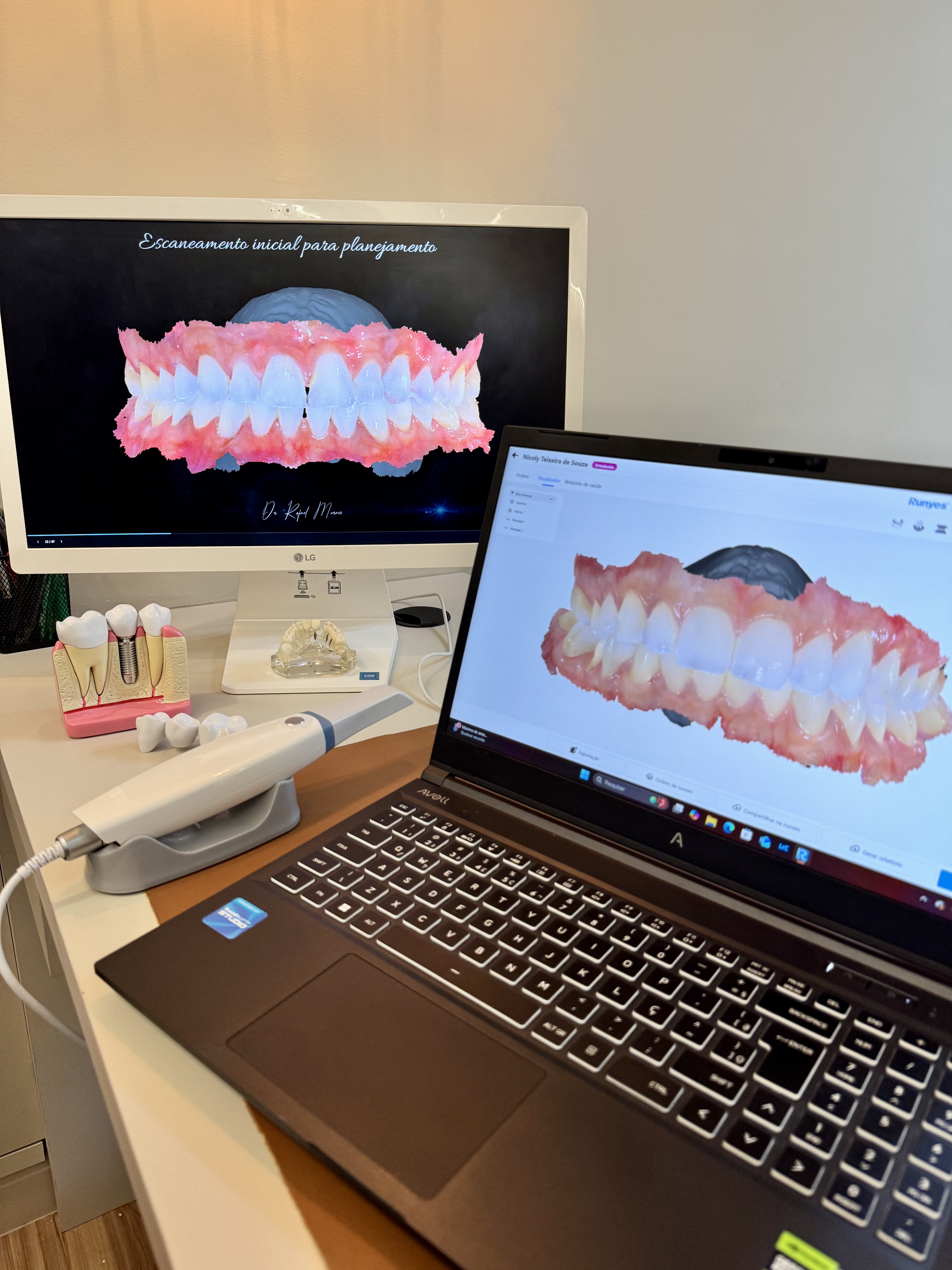Scanner Intraoral 3D